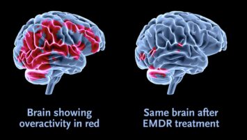 Brain activity EMDR